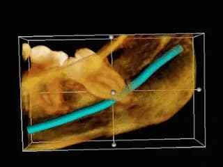 3D КТ: ретинированный зуб мудрости